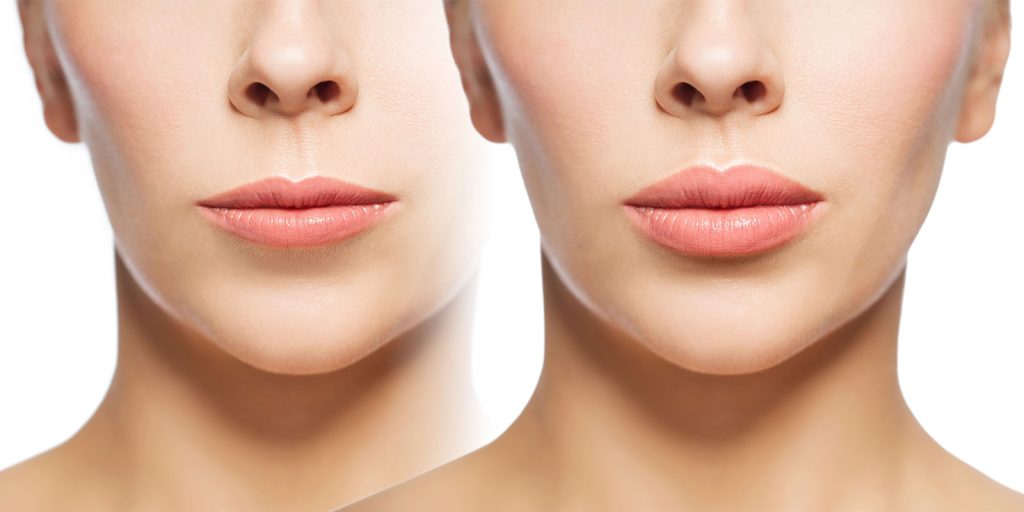 Russian lips täyteainehoito Revolax 1ml