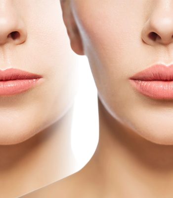 Russian lips täyteainehoito Revolax 1ml